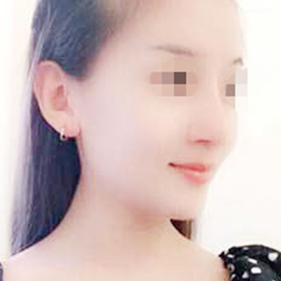 自體脂肪隆鼻術后一個月果分享，有前后對比照片喲~
