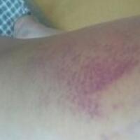 水動力吸脂減肥瘦大腿真實經(jīng)歷，抽脂后對比照片分享