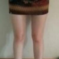 水動力吸脂減肥瘦大腿真實經(jīng)歷，抽脂后對比照片分享