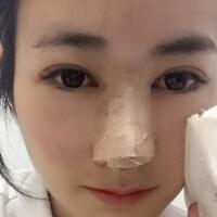 假體隆鼻圖片對比照片+鼻翼縮小親身經(jīng)歷