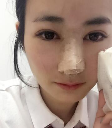 假體隆鼻+鼻翼縮小第4-5天的圖片