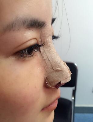 假體隆鼻+鼻翼縮小第4-5天的圖片