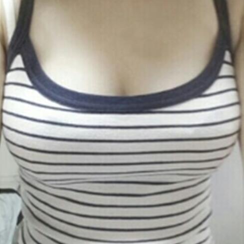 自體脂肪隆胸手術(shù)價格21800做的，恢復(fù)過程圖分享