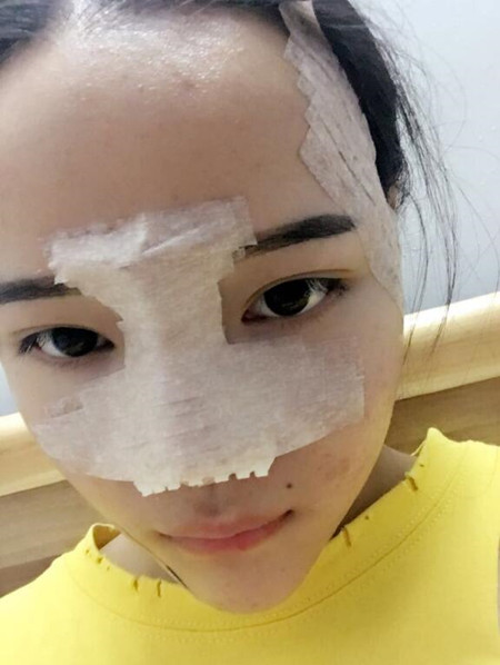 我的硅膠隆鼻+自體脂肪豐下巴+自體脂肪豐太陽穴恢復果案例日記