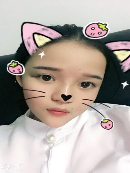 我的硅膠隆鼻+自體脂肪豐下巴+自體脂肪豐太陽穴恢復果案例日記