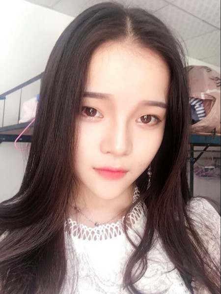 我的硅膠隆鼻+自體脂肪豐下巴+自體脂肪豐太陽穴恢復果案例日記