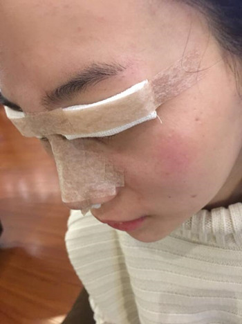 我的膨體隆鼻+雙眼皮手術(shù)讓我的顏值蹭蹭上升 內(nèi)有恢復(fù)果對比圖哦