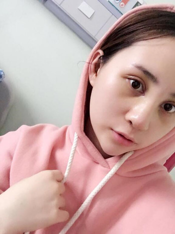 我的膨體隆鼻+雙眼皮手術(shù)讓我的顏值蹭蹭上升 內(nèi)有恢復(fù)果對比圖哦