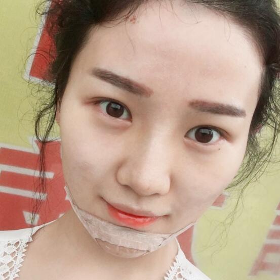 玻尿酸墊下巴手術(shù)恢復(fù)全過程圖片分享