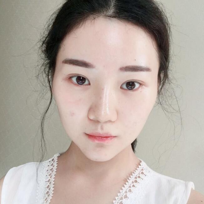 玻尿酸墊下巴手術(shù)恢復(fù)全過程圖片分享