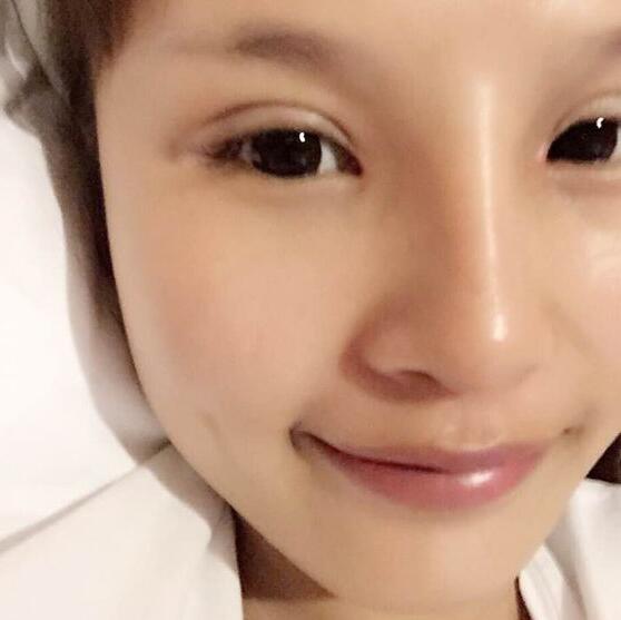 自體脂肪隆鼻+割雙眼皮的恢復(fù)過程讓我找到了自信