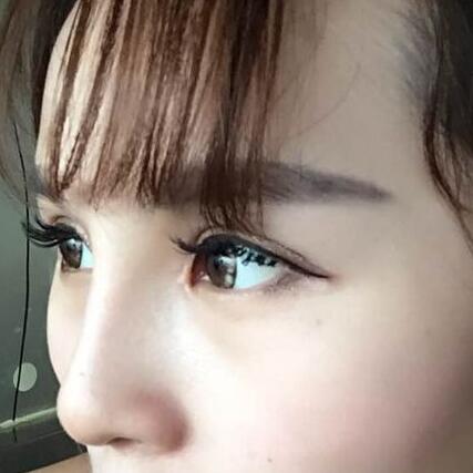 自體脂肪隆鼻+割雙眼皮的恢復(fù)過程讓我找到了自信