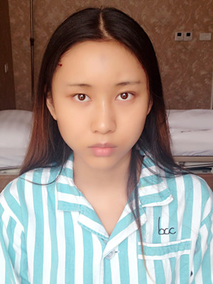 自體脂肪填充面部多圖分享還有術(shù)后小貼士哦