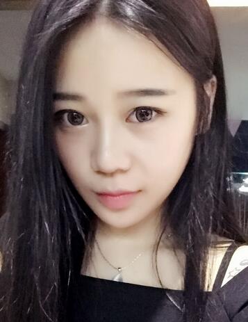 隆鼻拆線后鼻子圖片 硅膠隆鼻+鼻翼縮小恢復(fù)經(jīng)歷