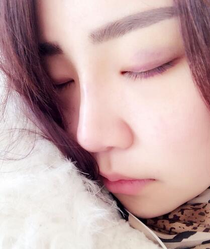 耳軟骨墊鼻尖三個月圖 耳軟骨墊鼻尖+硅膠隆鼻