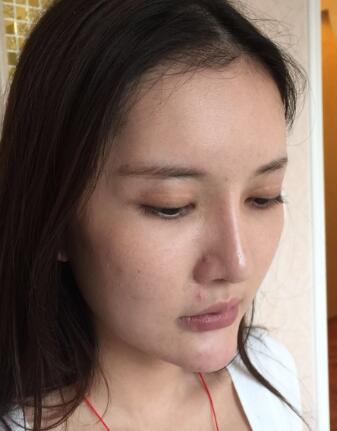 這是我做埋埋蛋白線.提升前拍的照片，看得出來面部肌膚走向下垂，皮膚松弛了