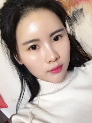 自體脂肪填充全臉經歷，臉型超**的