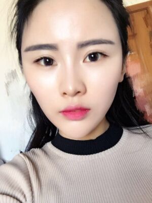 自體脂肪填充全臉經歷，臉型超**的