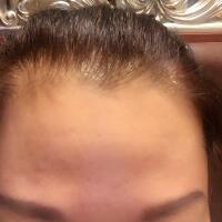 去抬頭紋很好的方法是注射注射瘦臉，恢復(fù)過程圖分享