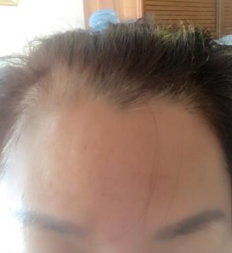 去抬頭紋很好的方法是注射注射瘦臉