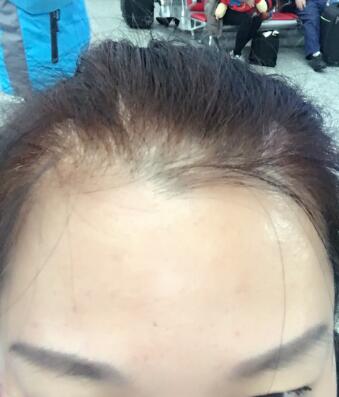 去抬頭紋很好的方法是注射注射瘦臉