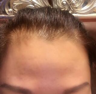 去抬頭紋很好的方法是注射注射瘦臉