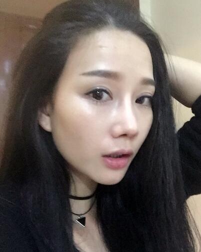 隆鼻整形真實(shí)恢經(jīng)歷 曬圖啦！