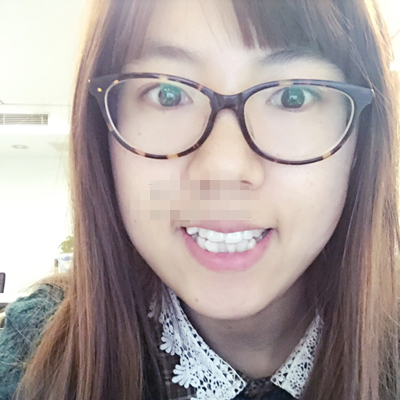 綿陽(yáng)朗睿梁勇生做的牙齒矯正，分享手術(shù)過(guò)程跟恢復(fù)果照片哦~