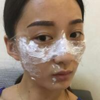 有誰做過激光祛雀斑？個人激光祛雀斑后恢復日記分享
