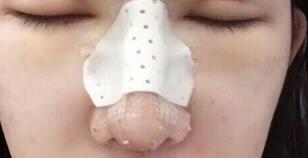 隆鼻失敗修復(fù)后恢復(fù)圖分享，鼻子修復(fù)價(jià)格9800元