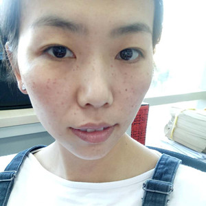激光祛曬斑真實案例分享，并附上前后對比圖片