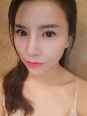 臉部埋埋蛋白線.提升果圖，真實(shí)經(jīng)歷分享