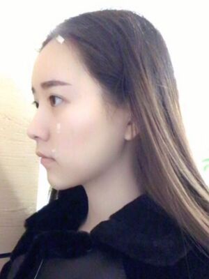 自體脂肪詳細(xì)部填充日記，恢復(fù)過(guò)程分享