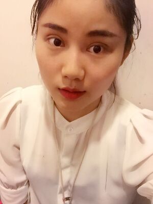 福州愛美爾切開雙眼皮消腫過程圖分享