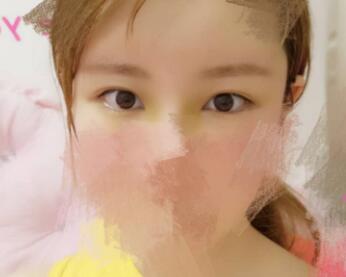 開內眼角割雙眼皮恢復全過程和圖片分享,雙眼皮多項整形整形