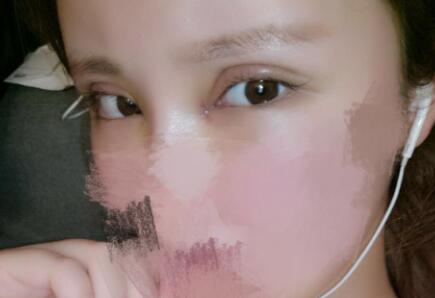 開內眼角割雙眼皮恢復全過程和圖片分享,雙眼皮多項整形整形