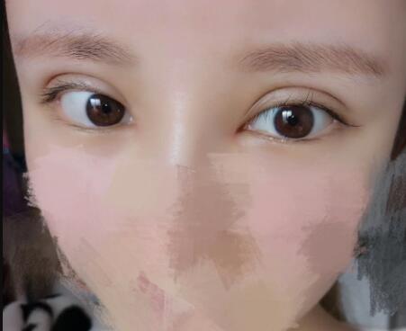 開內眼角割雙眼皮恢復全過程和圖片分享,雙眼皮多項整形整形