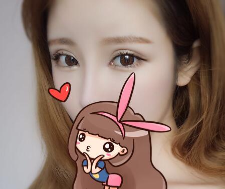 開內眼角割雙眼皮恢復全過程和圖片分享,雙眼皮多項整形整形