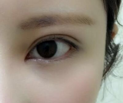 開內眼角割雙眼皮恢復全過程和圖片分享,雙眼皮多項整形整形