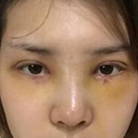 做了割雙眼皮和開內(nèi)眼角雙眼皮多項整形整形手術(shù)，恢復(fù)圖片日志分享