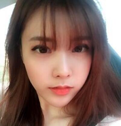 做了割雙眼皮和開內(nèi)眼角雙眼皮多項整形整形手術(shù),恢復圖片日志分享