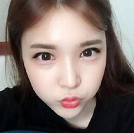 做了割雙眼皮和開內(nèi)眼角雙眼皮多項整形整形手術(shù),恢復圖片日志分享