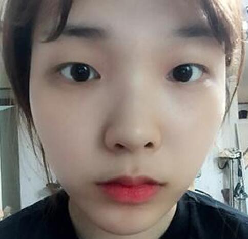 做了割雙眼皮和開內(nèi)眼角雙眼皮多項整形整形手術(shù),恢復圖片日志分享