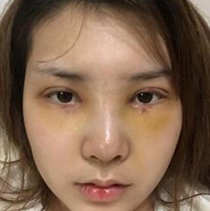 做了割雙眼皮和開內(nèi)眼角雙眼皮多項整形整形手術(shù),恢復圖片日志分享