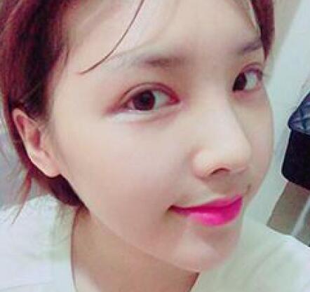 做了割雙眼皮和開內(nèi)眼角雙眼皮多項整形整形手術(shù),恢復圖片日志分享