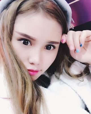 雙眼皮失敗修復果圖，福州愛美爾王召克做的