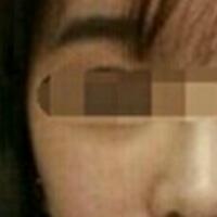 在濟(jì)南吉芙醫(yī)院做的玻尿酸填充淚溝，填充淚溝圖片分享