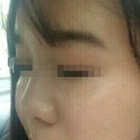 在濟(jì)南吉芙醫(yī)院做的玻尿酸填充淚溝，填充淚溝圖片分享