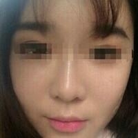 在濟(jì)南吉芙醫(yī)院做的玻尿酸填充淚溝，填充淚溝圖片分享