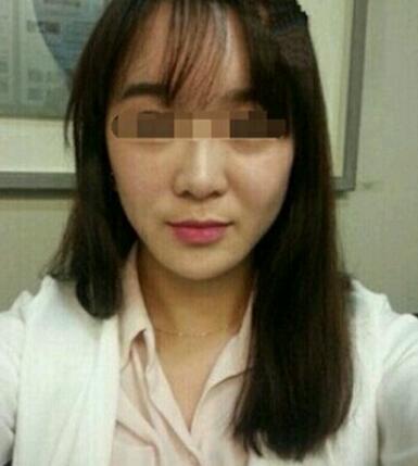 在濟(jì)南吉芙醫(yī)院做的玻尿酸填充淚溝,填充淚溝圖片分享